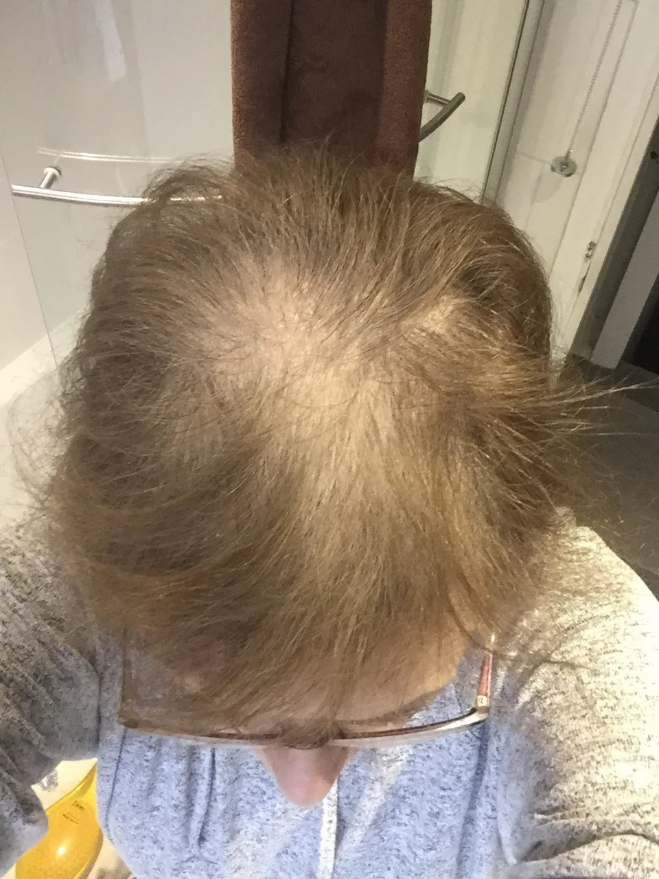 Janice B. before