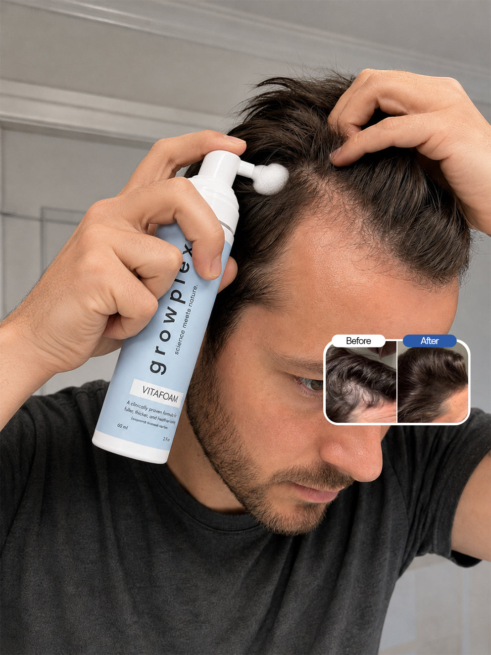 The 5% Minoxidil foam for men, without irritation.