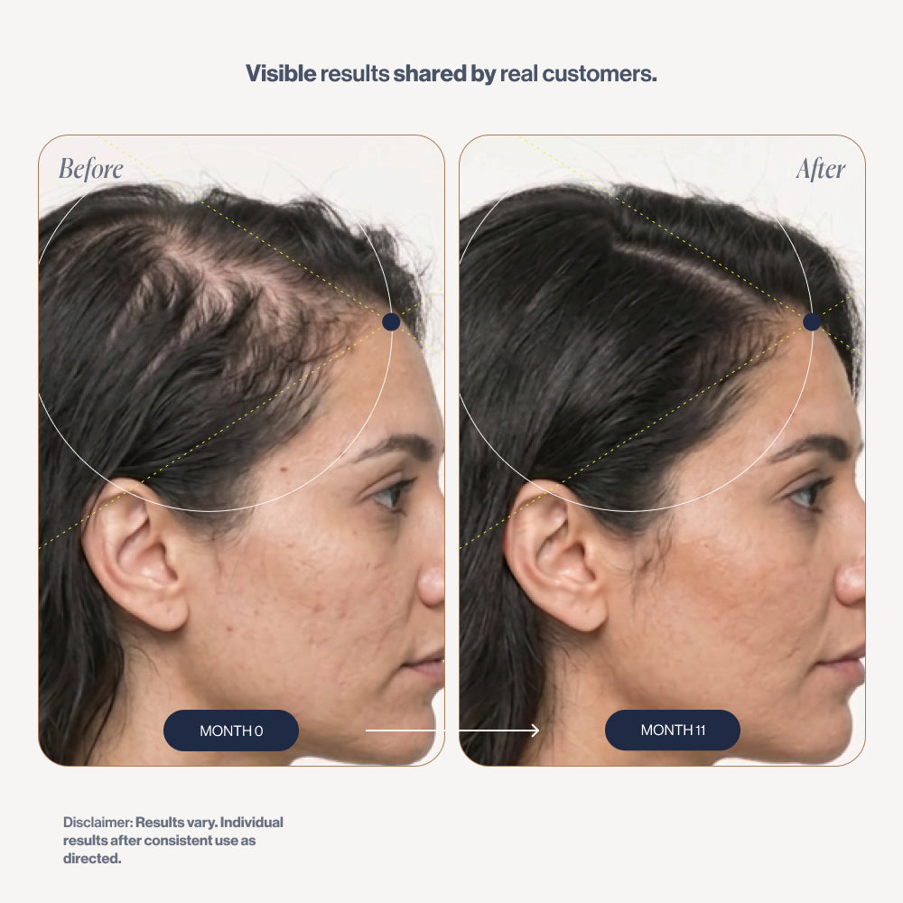 Scalp Roller 2.0 before and after results (women)
