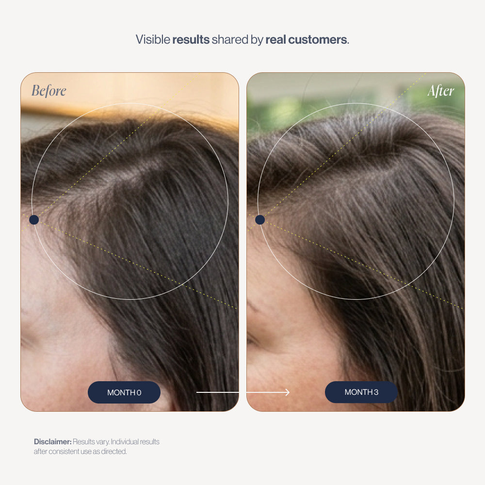 Hair Loss Prevention Kit before and after results
