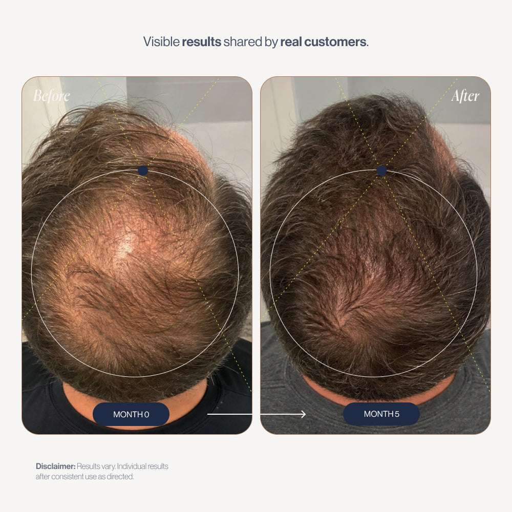 Revive before and after results (men)