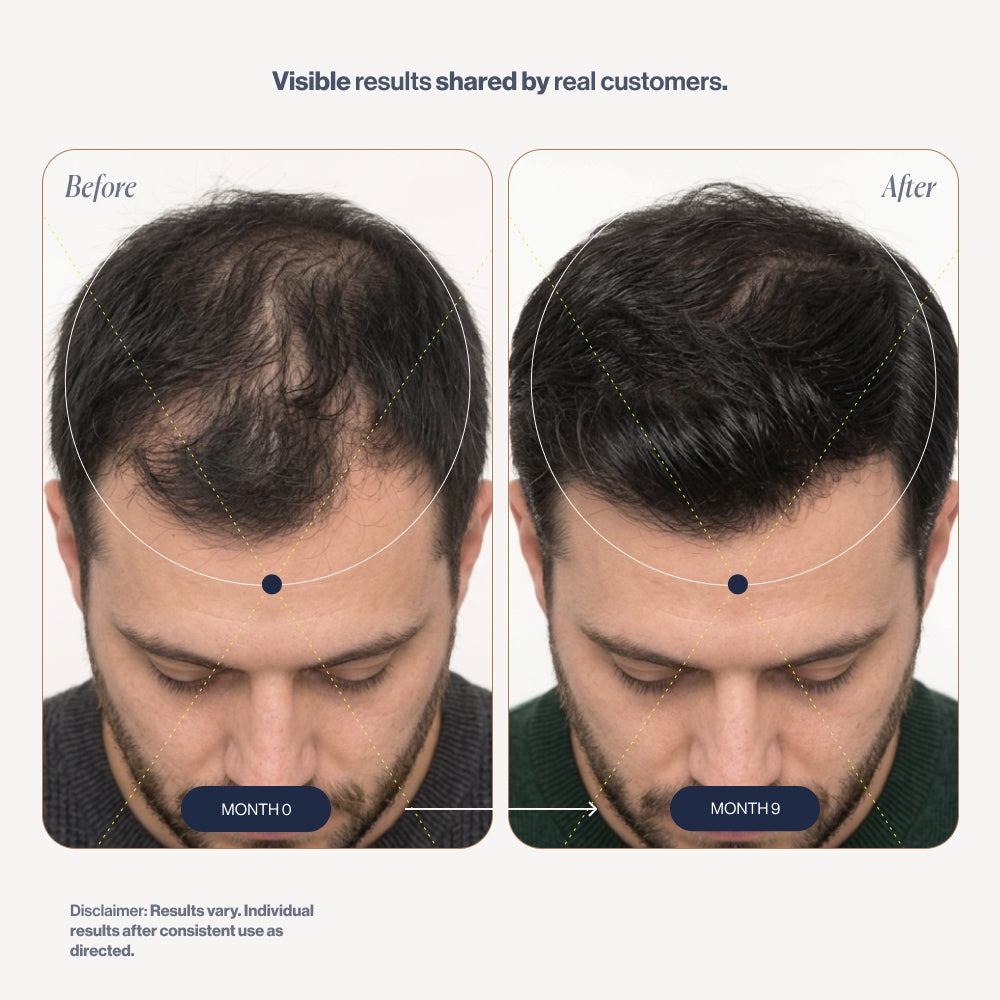 Scalp Roller 2.0 before and after results (men)