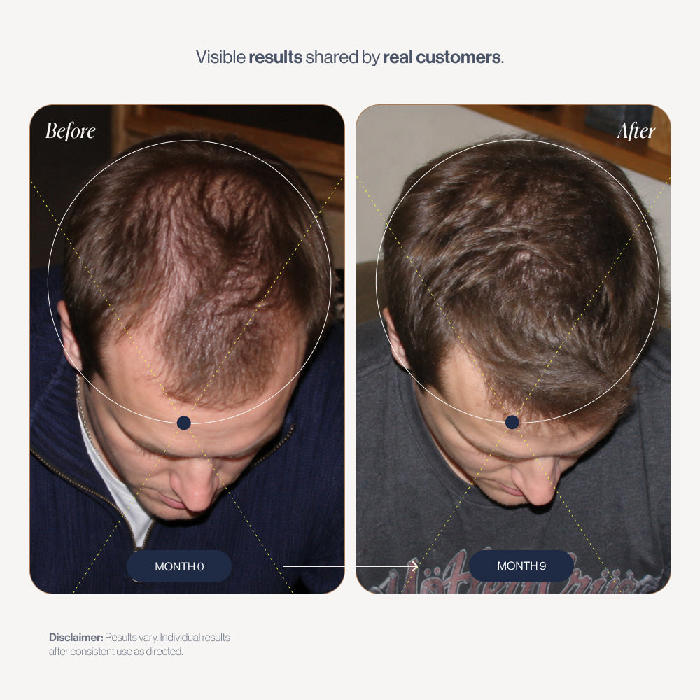 Rosemary Elixir before and after results (men)
