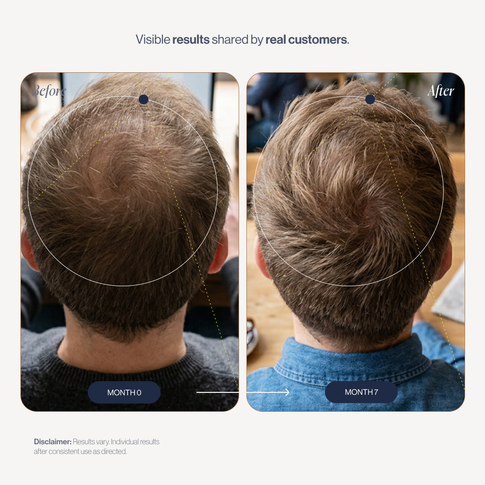 Hair Loss Prevention Kit before and after results (2)