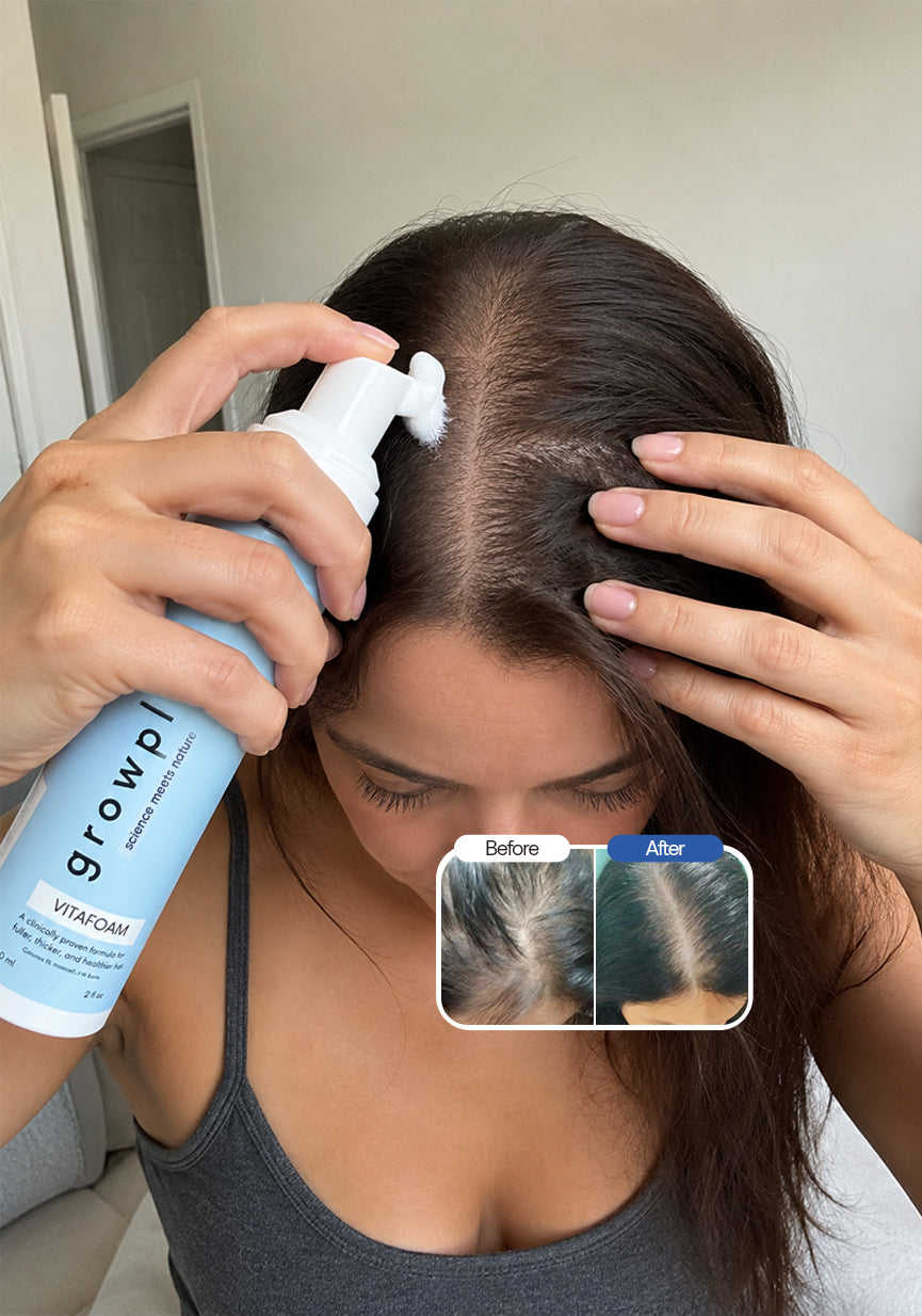The 5% Minoxidil foam for women, without irritation.