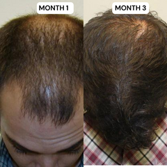Hair Growth Kit