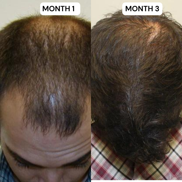 Hair Growth Kit