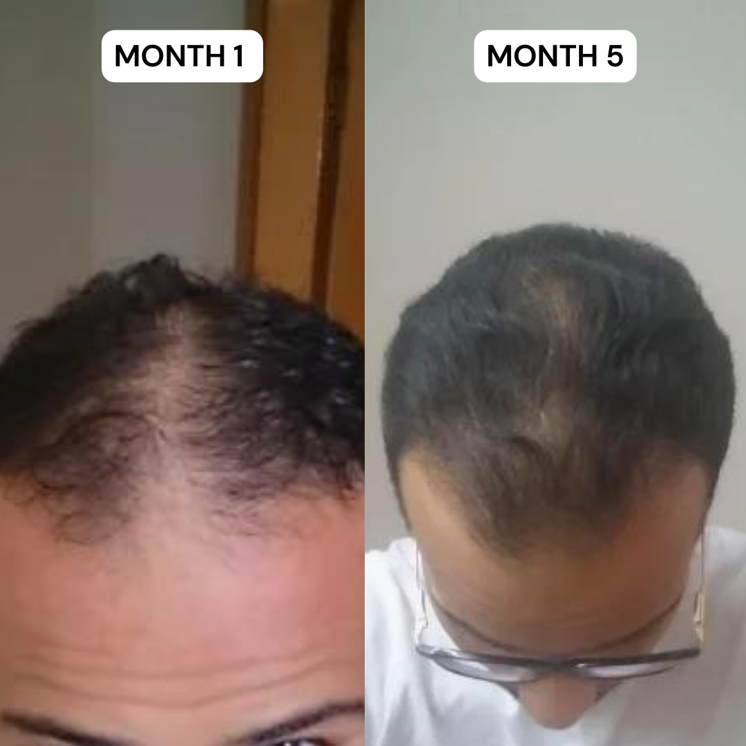 Complex10™ Hair Growth Supplement