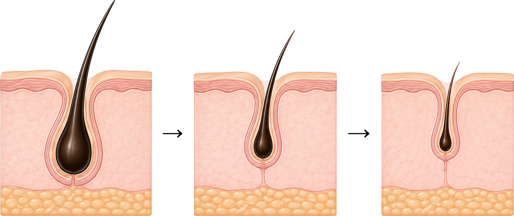 What Happens to hair follicles