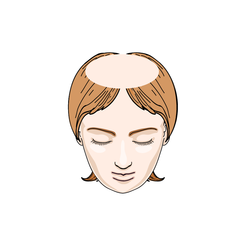 Patches of Hair Loss