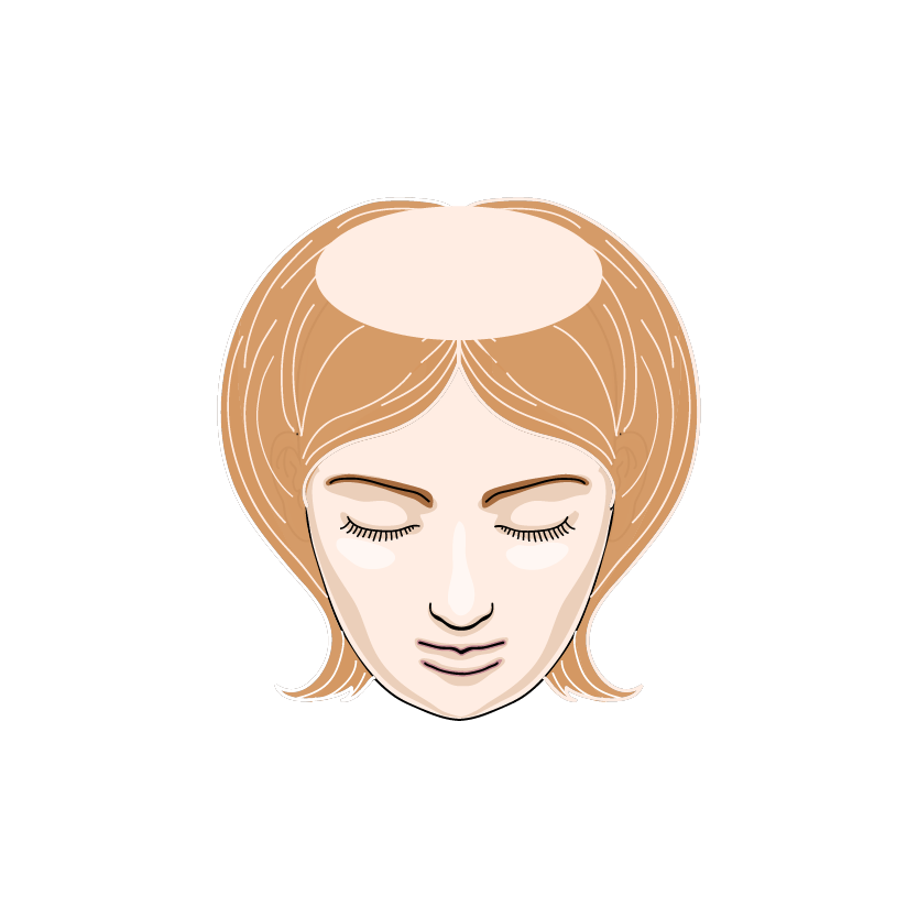 Thinning and Scalp Visibility