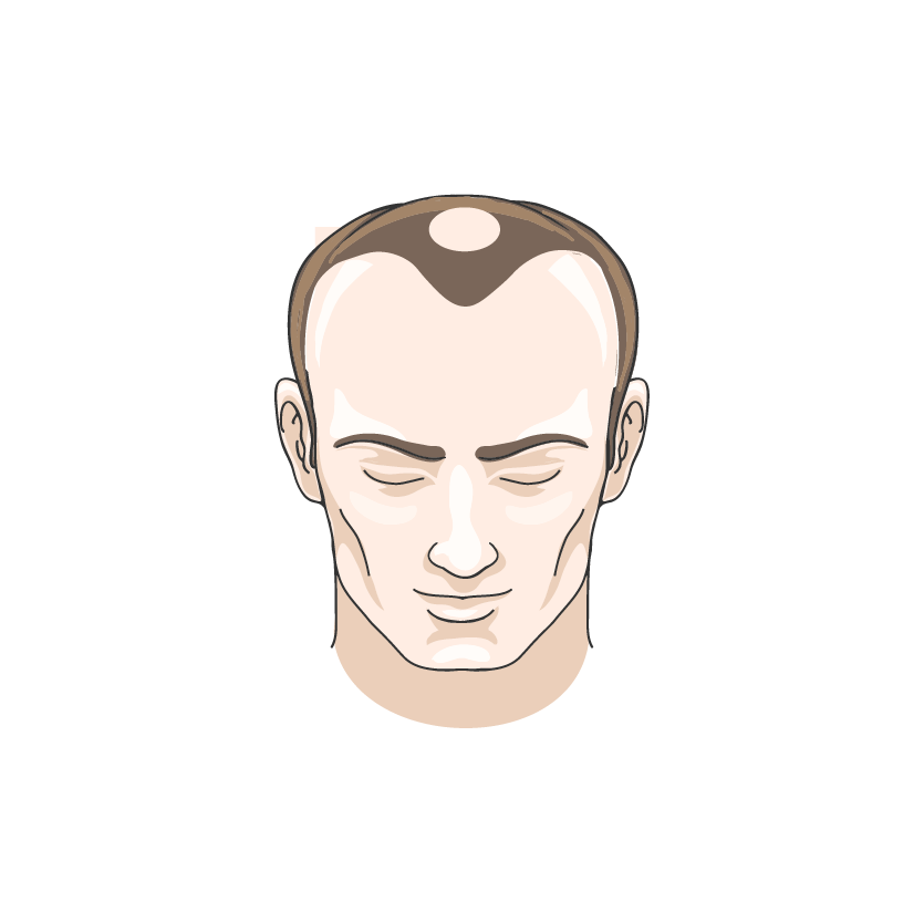 Hairline and Crown