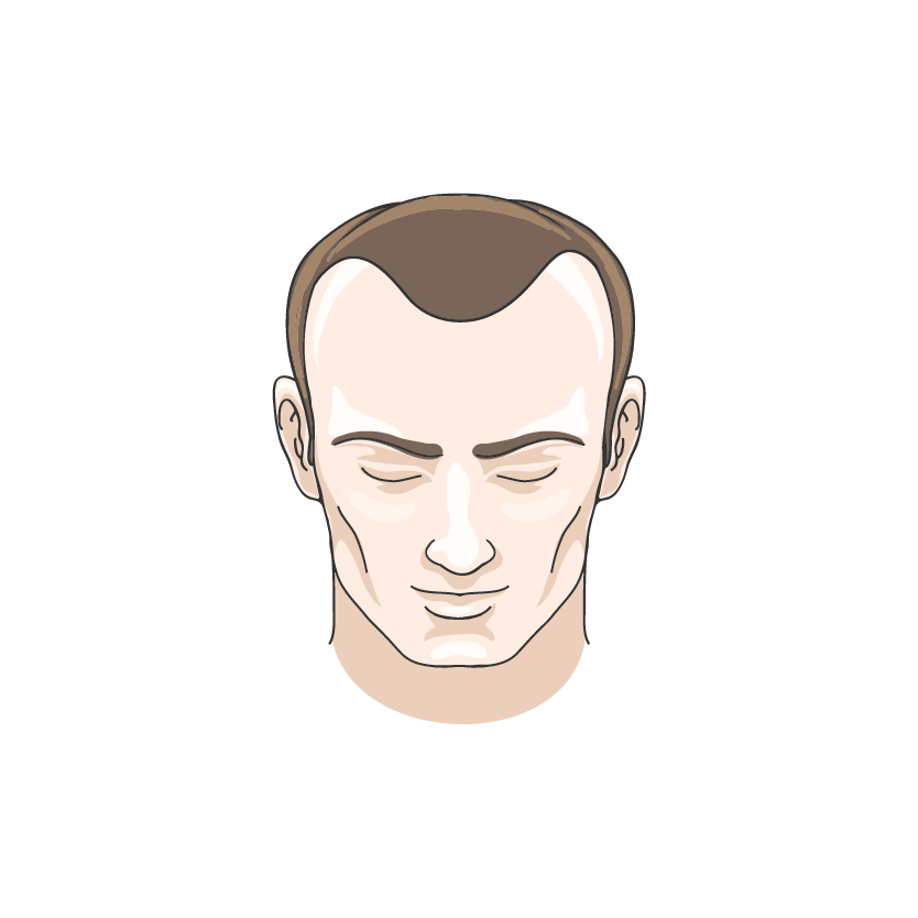Along The Hairline
