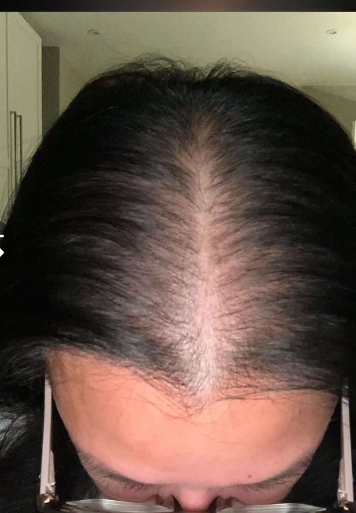 Angela B., a Growplex customer, before and two months in: her part line looks fuller