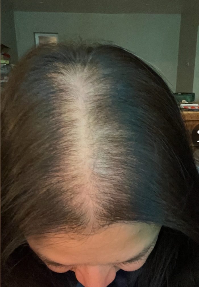 Angela B., a Growplex customer, before and two months in: her part line looks fuller