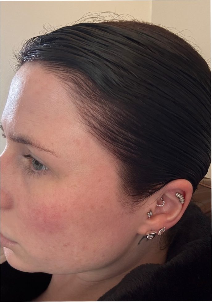 Emma D., a Growplex customer, month one and month three: her hairline looks fuller