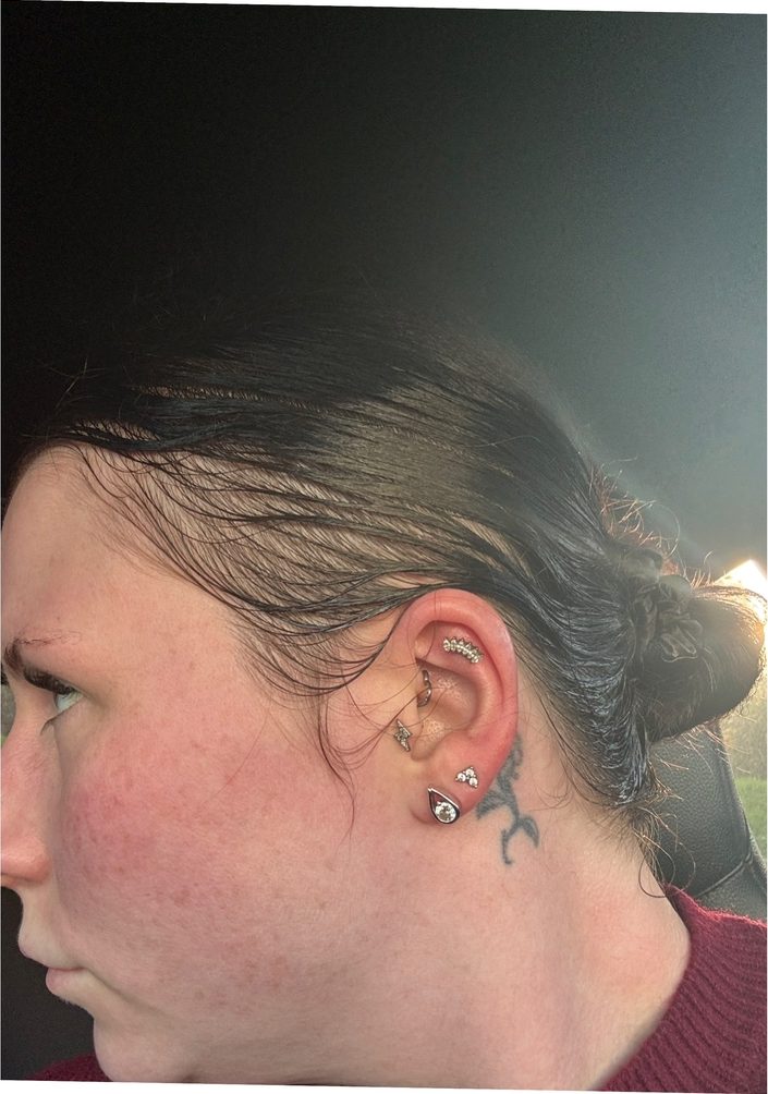Emma D., a Growplex customer, month one and month three: her hairline looks fuller