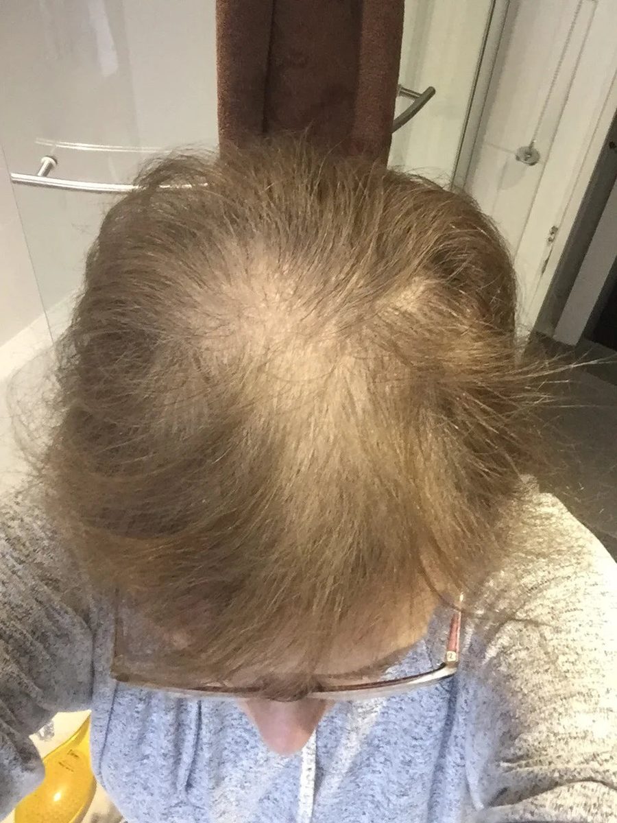 Janice B., a Growplex customer, before and four months later: her crown looks fuller