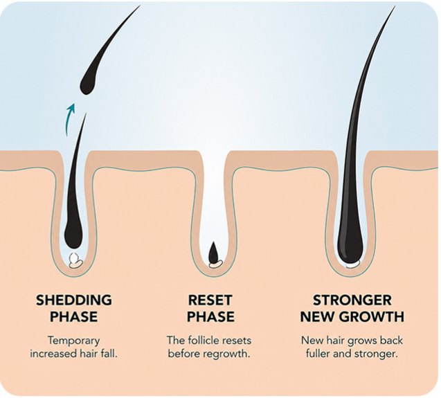Illustration of the hair cycle: shedding phase, reset phase, stronger new growth