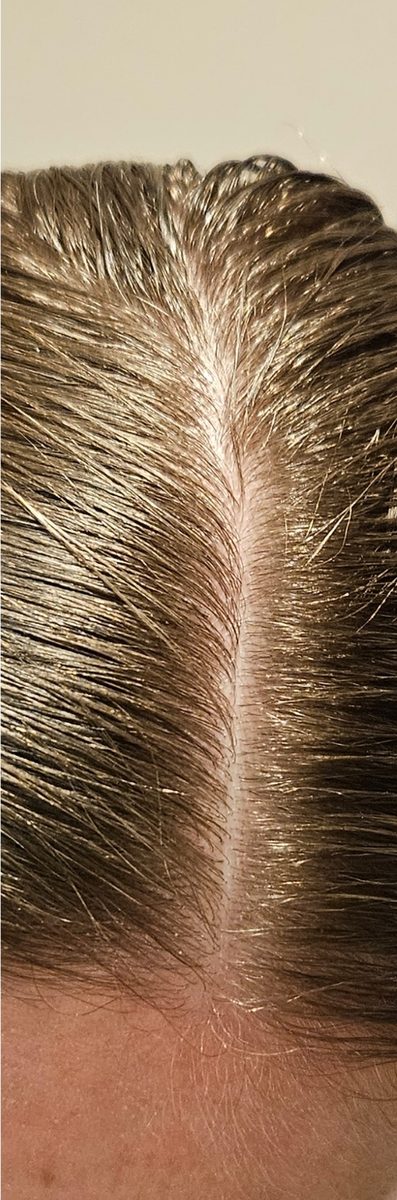 Michaela C., a Growplex customer, before and after: baby hairs filling in along the part
