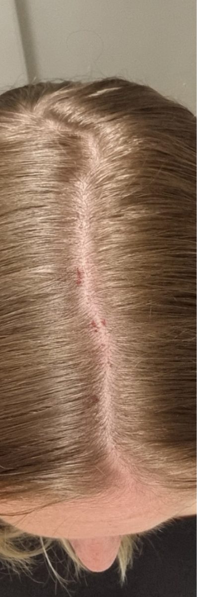 Michaela C., a Growplex customer, before and after: baby hairs filling in along the part