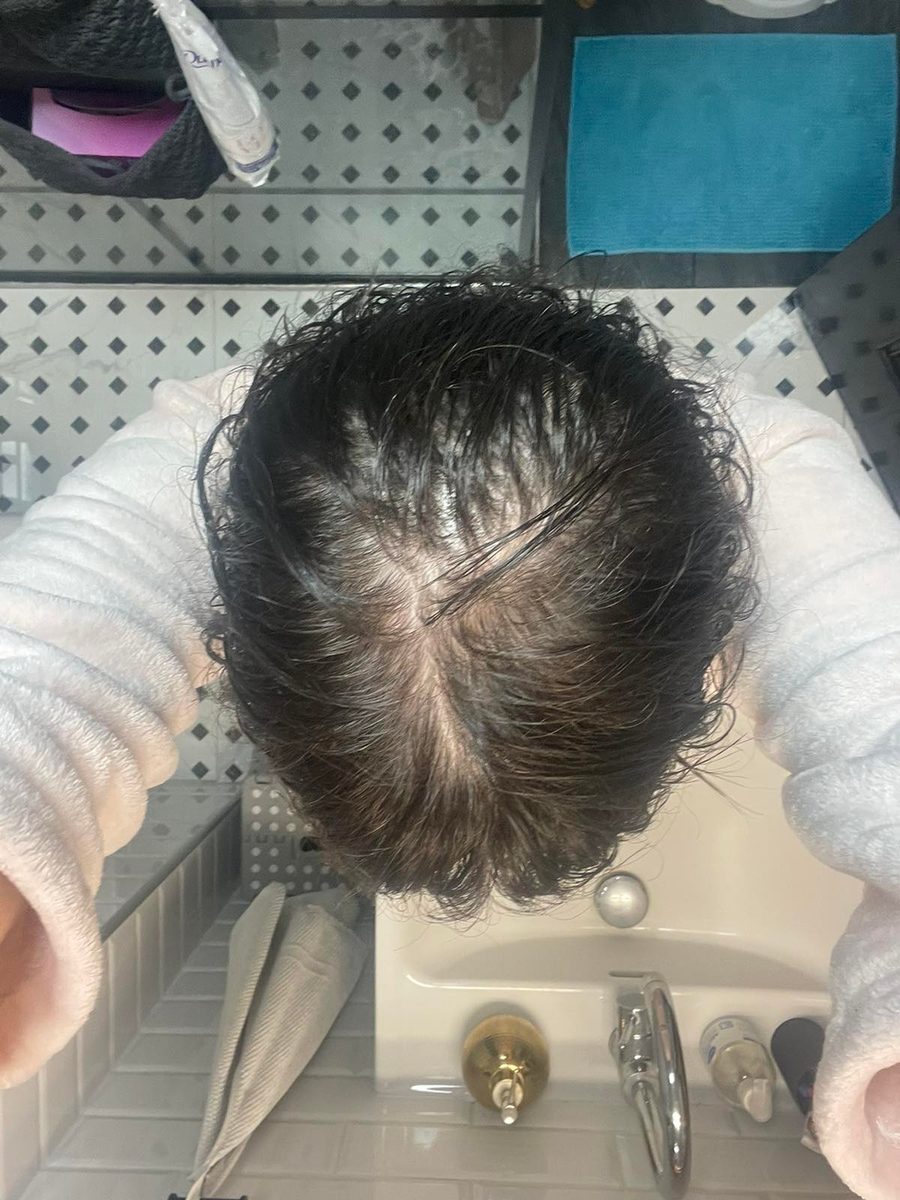 Mija R., a Growplex customer, day 1 and day 150: her crown looks fuller