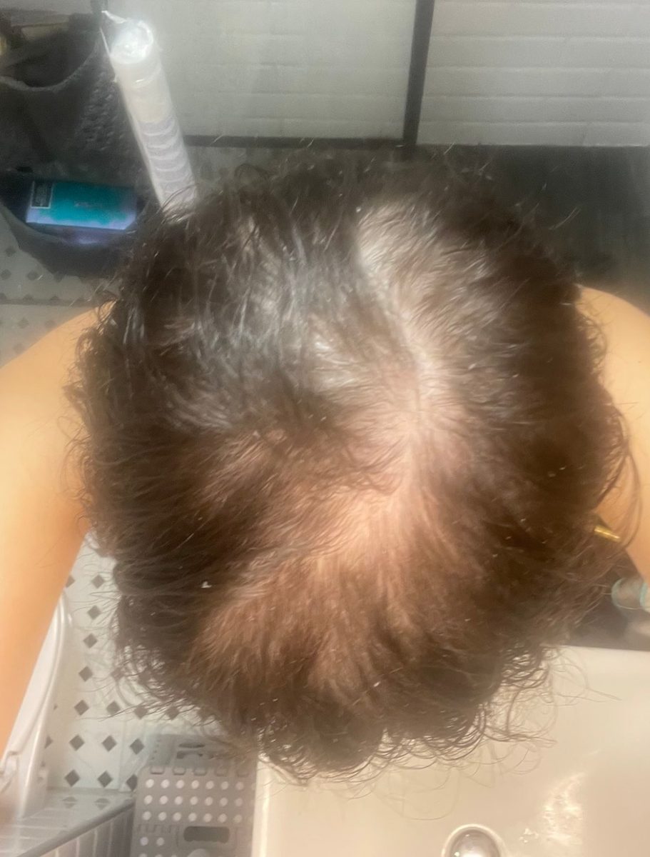 Mija R., a Growplex customer, day 1 and day 150: her crown looks fuller