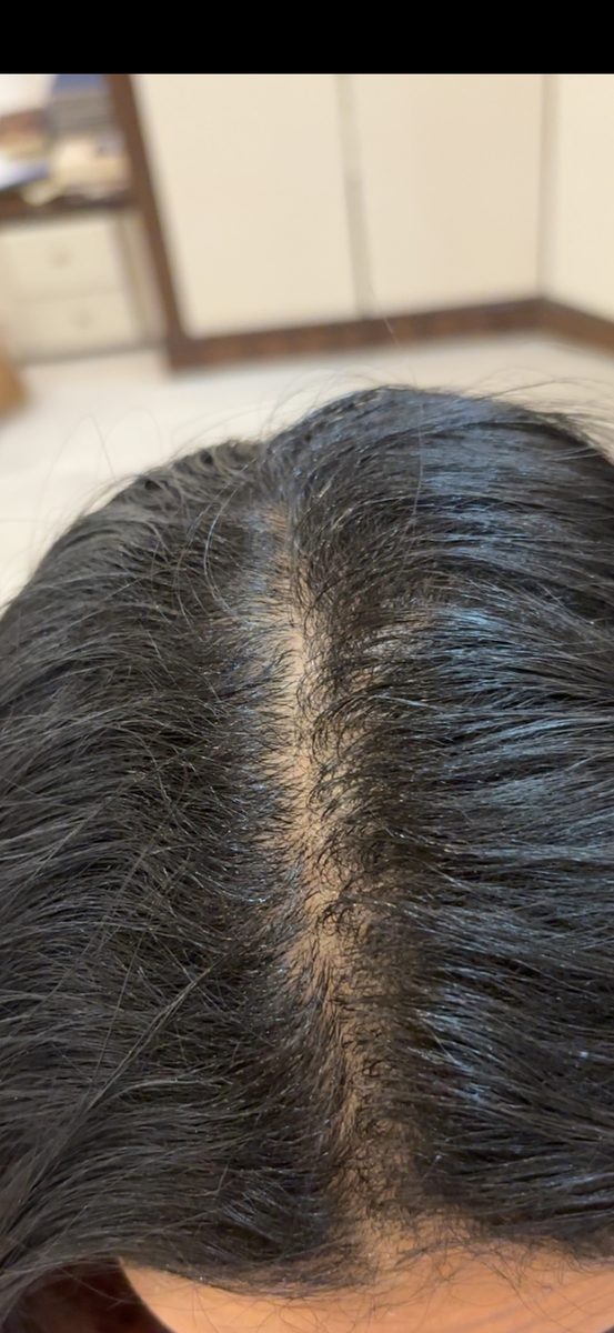 Rawan A., a Growplex customer, her start photo and new baby hairs along the part