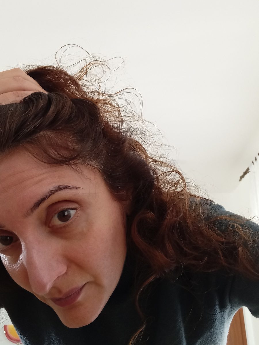 Sanaria I., a Growplex customer, showing her hairline