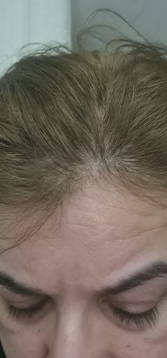 Shireen P., a Growplex customer, before and after: less visible scalp along the part