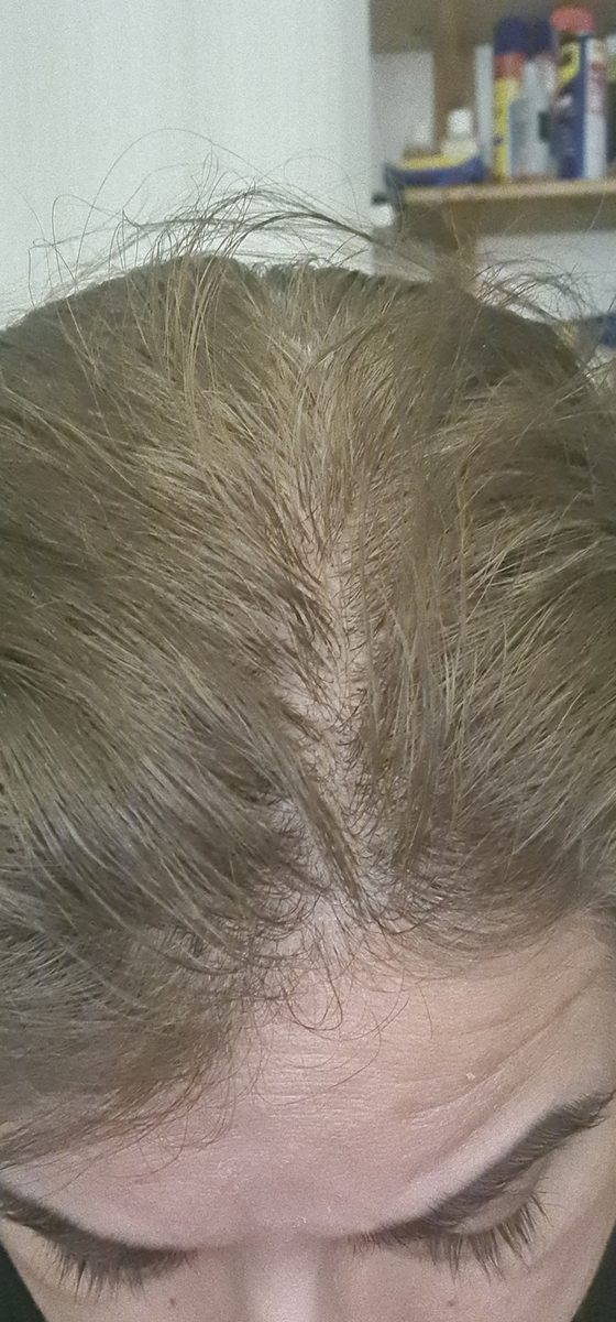 Shireen P., a Growplex customer, before and after: less visible scalp along the part